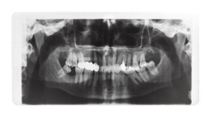 牙痛困擾？瞭解牙止痛藥的正確使用